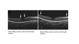 Focal VMA ( arrows ) with normal foveal
contour.
Broad VMA ( arrows ) with normal foveal
contour.
 
