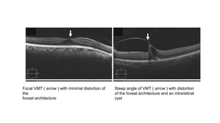 Focal VMT ( arrow ) with minimal distortion of
the
foveal architecture
Steep angle of VMT ( arrow ) with distortion
of the foveal architecture and an intraretinal
cyst
 