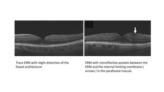 Trace ERM with slight distortion of the
foveal architecture
ERM with nonreflective pockets between the
ERM and the internal limiting membrane (
arrows ) in the parafoveal macula
 