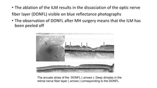 • The ablation of the ILM results in the dissociation of the optic nerve
fiber layer (DONFL) visible on blue reflectance photographs
• The observation of DONFL after MH surgery means that the ILM has
been peeled off
The arcuate striae of the DONFL ( arrows ). Deep dimples in the
retinal nerve fiber layer ( arrows ) corresponding to the DONFL
 