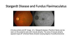 Stargardt Disease and Fundus Flavimaculatus
A fundus photo and AF image of a Stargardt disease -Pisciform flecks can be
seen on the posterior pole with macula atrophy. The area of macula atrophy
appears hypo-AF whereas flecks showed varying degree of autofluorescence
 