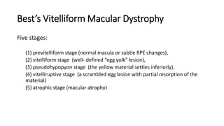 Best’s Vitelliform Macular Dystrophy
Five stages:
(1) previtelliform stage (normal macula or subtle RPE changes),
(2) vitelliform stage (well- defined “egg yolk” lesion),
(3) pseudohypopyon stage (the yellow material settles inferiorly),
(4) vitelliruptive stage (a scrambled egg lesion with partial resorption of the
material)
(5) atrophic stage (macular atrophy)
 