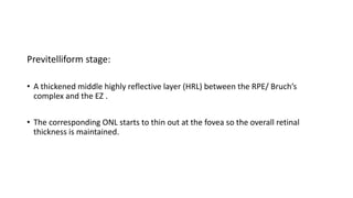 Previtelliform stage:
• A thickened middle highly reflective layer (HRL) between the RPE/ Bruch’s
complex and the EZ .
• The corresponding ONL starts to thin out at the fovea so the overall retinal
thickness is maintained.
 