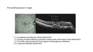 Pseudohypopyon stage
( 1 ) a localised neurosensory retinal detachment
( 2 ) clumps of hyper-reflective subretinal material seen at the base of this detachment.
( 3 ) The ONL was thinned with focal regions of heterogenous reflectivity
( 4 ) a pigment epithelial detachment
 