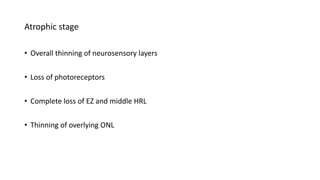 Atrophic stage
• Overall thinning of neurosensory layers
• Loss of photoreceptors
• Complete loss of EZ and middle HRL
• Thinning of overlying ONL
 