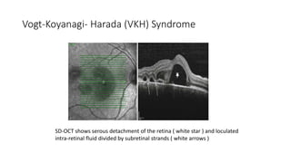 Vogt-Koyanagi- Harada (VKH) Syndrome
SD-OCT shows serous detachment of the retina ( white star ) and loculated
intra-retinal fluid divided by subretinal strands ( white arrows )
 