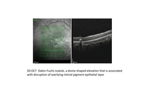 SD OCT Dalen-Fuchs nodule, a dome-shaped elevation that is associated
with disruption of overlying retinal pigment epithelial layer
 