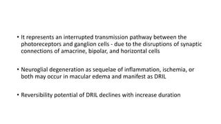• It represents an interrupted transmission pathway between the
photoreceptors and ganglion cells - due to the disruptions of synaptic
connections of amacrine, bipolar, and horizontal cells
• Neuroglial degeneration as sequelae of inflammation, ischemia, or
both may occur in macular edema and manifest as DRIL
• Reversibility potential of DRIL declines with increase duration
 