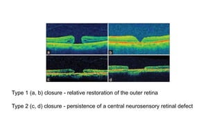 Type 1 (a, b) closure - relative restoration of the outer retina
Type 2 (c, d) closure - persistence of a central neurosensory retinal defect
 