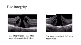 ELM integrity
ELM integrity good –ELM intact
upto hole edges in both edges
ELM integrity partial-ill defined or
discontinuos
 