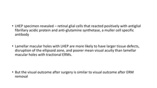 • LHEP specimen revealed – retinal glial cells that reacted positively with antiglial
fibrillary acidic protein and anti-glutamine synthetase, a muller cell specific
antibody
• Lamellar macular holes with LHEP are more likely to have larger tissue defects,
disruption of the ellipsoid zone, and poorer mean visual acuity than lamellar
macular holes with tractional ERMs.
• But the visual outcome after surgery is similar to visual outcome after ERM
removal
 