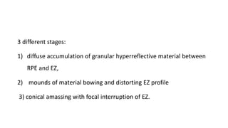 3 different stages:
1) diffuse accumulation of granular hyperreflective material between
RPE and EZ,
2) mounds of material bowing and distorting EZ profile
3) conical amassing with focal interruption of EZ.
 