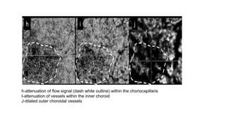 h-attenuation of flow signal (dash white outline) within the choriocapillaris
I-attenuation of vessels within the inner choroid
J-dilated outer choroidal vessels
 