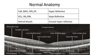 Normal Anatomy
ILM, RNFL, OPL,IPL Hyper Reflective
GCL, INL,ONL Hypo Reflective
Retinal Vessels Circular hyper reflective
 