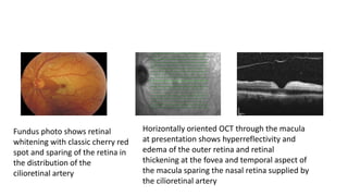 Fundus photo shows retinal
whitening with classic cherry red
spot and sparing of the retina in
the distribution of the
cilioretinal artery
Horizontally oriented OCT through the macula
at presentation shows hyperreflectivity and
edema of the outer retina and retinal
thickening at the fovea and temporal aspect of
the macula sparing the nasal retina supplied by
the cilioretinal artery
 