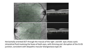 Horizontally oriented OCT through the macula of the right and left eyes shows cystic
intraretinal fluid involving the fovea of both eyes, with thinning and disruption of the IS-OS
junction, consistent with idiopathic macular telangiectasia type 2A
 