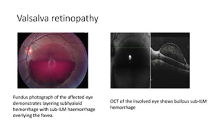 Valsalva retinopathy
Fundus photograph of the affected eye
demonstrates layering subhyaloid
hemorrhage with sub-ILM haemorrhage
overlying the fovea.
OCT of the involved eye shows bullous sub-ILM
hemorrhage
 