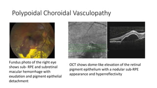 Polypoidal Choroidal Vasculopathy
Fundus photo of the right eye
shows sub- RPE and subretinal
macular hemorrhage with
exudation and pigment epithelial
detachment
OCT shows dome-like elevation of the retinal
pigment epithelium with a nodular sub-RPE
appearance and hyperreflectivity
 