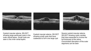 Cystoid macular edema. SD-OCT
showing large perifoveal cysts in the
outer retinal layers. Small cysts are
seen in the inner rental layers
Cystoid macular edema. SD-OCT
showing small cysts that have
coalesced to form one large cyst
Severe cystoid macular edema.
SD-OCT showing cystic cavities
that have expanded to involve the
full thickness of the retina.
Concomitant disruption of the outer
segments can be seen
 