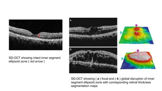 Optical coherence tomography)(OCT) | PPTX