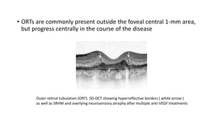 • ORTs are commonly present outside the foveal central 1-mm area,
but progress centrally in the course of the disease
Outer retinal tubulation (ORT). SD-OCT showing hyperreflective borders ( white arrow )
as well as SRHM and overlying neurosensory atrophy after multiple anti-VEGF treatments
 