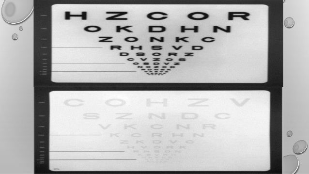 Oct Eye Test Multiple Sclerosis