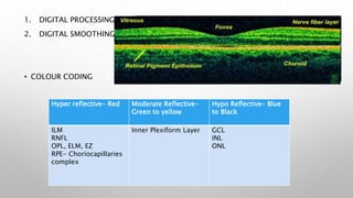 1. DIGITAL PROCESSING
2. DIGITAL SMOOTHING
• COLOUR CODING
Hyper reflective- Red Moderate Reflective-
Green to yellow
Hypo Reflective- Blue
to Black
ILM
RNFL
OPL, ELM, EZ
RPE- Choriocapillaries
complex
Inner Plexiform Layer GCL
INL
ONL
 