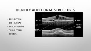 IDENTIFY ADDITIONAL STRUCTURES
• PRE- RETINAL
• EPI- RETINAL
• INTRA- RETINAL
• SUB- RETINAL
• SUB RPE
 