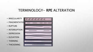 TERMINOLOGY- RPE ALTERATION
• IRREGULARITY
• FRAGMENTATION
• RUPTURE
• INTERRUPTION
• DEPRESSION
• ELEVATION
• THINNING
• THICKENING
 