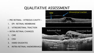 QUALITATIVE ASSESSMENT
• PRE RETINAL- VITREOUS CAVITY:-
1. EPI- RETINAL MEMBRANE
2. VITREORETINAL TRACTION
• INTRA RETINAL CHANGES
1. CME
2. CNV
3. HARD EXUDATES
4. INTRA RETINAL HAEMORRHAGES
Vitreoretinal traction
ERM
 