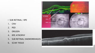 • SUB RETINAL/ RPE
1. CNV
2. PED
3. DRUSEN
4. RPE ATROPHY
5. SUB RETINAL HAEMORRHAGES
6. SCAR TISSUE
 
