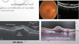 MICRO ANEURYSM
•SMALL OUTPOUCHINGS OF MACULAR
CAPILLARY BED
RPE BREAK
 