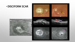 • DISCIFORM SCAR
 