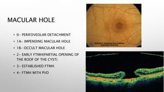 MACULAR HOLE
• 0- PERIFOVEOLAR DETACHMENT
• 1A- IMPENDING MACULAR HOLE
• 1B- OCCULT MACULAR HOLE
• 2- EARLY FTMH(PARTIAL OPENING OF
THE ROOF OF THE CYST)
• 3- ESTABLISHED FTMH
• 4- FTMH WITH PVD
 