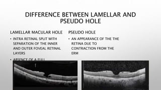 DIFFERENCE BETWEEN LAMELLAR AND
PSEUDO HOLE
LAMELLAR MACULAR HOLE
• INTRA RETINAL SPLIT WITH
SEPARATION OF THE INNER
AND OUTER FOVEAL RETINAL
LAYERS
• ABSENCE OF A FULL
THICKNESS FOVEAL DEFECT
PSEUDO HOLE
• AN APPEARANCE OF THE THE
RETINA DUE TO
CONTRACTION FROM THE
ERM
 