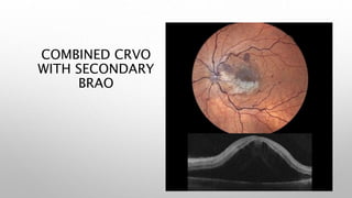 COMBINED CRVO
WITH SECONDARY
BRAO
 