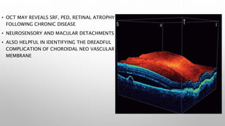• OCT MAY REVEALS SRF, PED, RETINAL ATROPHY
FOLLOWING CHRONIC DISEASE
• NEUROSENSORY AND MACULAR DETACHMENTS
• ALSO HELPFUL IN IDENTIFYING THE DREADFUL
COMPLICATION OF CHOROIDAL NEO VASCULAR
MEMBRANE
 