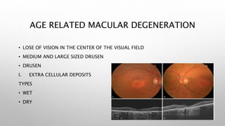AGE RELATED MACULAR DEGENERATION
• LOSE OF VISION IN THE CENTER OF THE VISUAL FIELD
• MEDIUM AND LARGE SIZED DRUSEN
• DRUSEN
I. EXTRA CELLULAR DEPOSITS
TYPES
• WET
• DRY
 