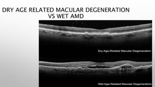 DRY AGE RELATED MACULAR DEGENERATION
VS WET AMD
 