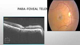 PARA-FOVEAL TELENGECTASIA
 