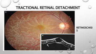 TRACTIONAL RETINAL DETACHMENT
RETINOSCHISI
S
 