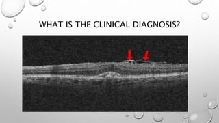 WHAT IS THE CLINICAL DIAGNOSIS?
 
