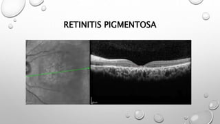 RETINITIS PIGMENTOSA
 