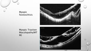 Myopic
foveoschisis
Myopic Traction
Maculopathy(MT
M)
 