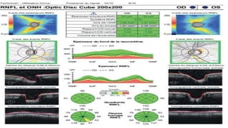 RNFL AND OCT
DISC
1. CHECK THE SIGNAL STRENGTH
2. RNFL THICKNESS MAP
3. RNFL DEVIATION MAP
4. RNFL GRAPH
5. NRR THICKNESS
6. HORIZONDAL ND VERTICAL EXTRACTED TOMOGRAMS
7. RNFL THICKNESS QUADRANTS
8. RNFL CIRCULAR TOMOGRAM
 
