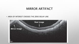 MIRROR ARTIFACT
• AREA OF INTEREST CROSSES THE ZERO DELAY LINE
 