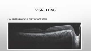 VIGNETTING
• WHEN IRIS BLOCKS A PART OF OCT BEAM
 
