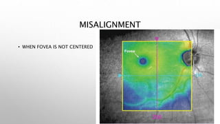 MISALIGNMENT
• WHEN FOVEA IS NOT CENTERED
 