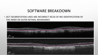 SOFTWARE BREAKDOWN
• OCT SEGMENTATION LINES ARE INCORRECT BCOZ OF MIS IDENTIFICATION OF
THE INNER OR OUTER RETINAL BOUNDARIES
 