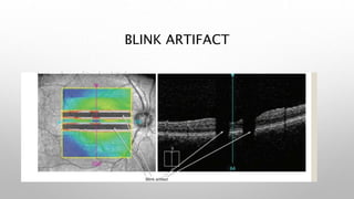 BLINK ARTIFACT
• DURING IMAGE AQUISITION
 